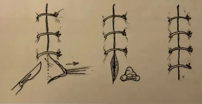 手绘插图,分三组展示手术缝合与拆线的步骤:持刀切开、打结固定缝线、拆除缝线结。